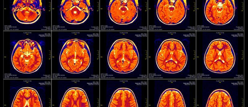 MRI demonstrates brain disruption children with PTSD - Neuro Central